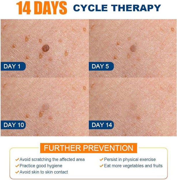 Picture of Wart Remover